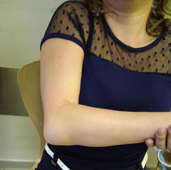 Tak wyglądała ręka Anny po niedzielnej manifestacji.