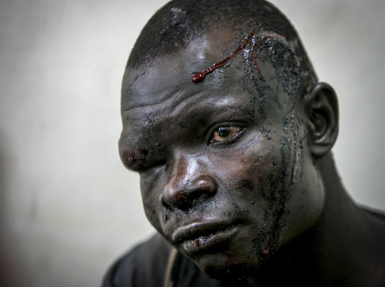 Ofiara starć międzyplemiennych w szpitalu w Nakuru.