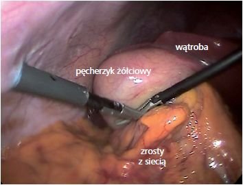 Na zdjęciu widoczne pęcherzyk żółciowy oraz narzędzia chirurgiczne, wprowadzone przez mikroporty do jamy brzusznej.