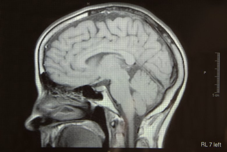Skutkiem Uszkodzenia Móżdżku Są Zaburzenia Aż 20 proc. Polaków ma zaburzenia psychiczne. "Kobiety są płaczliwe