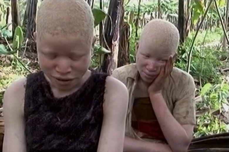 SÄ… zabijani i okaleczani, bo z kawaÅ‚kÃ³w ich ciaÅ‚ robi siÄ™ amulety. Albinosi w Tanzanii cenniejsi niÅ¼ koÅ›Ä‡ sÅ‚oniowa